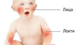 Фото: Чесотка у детей