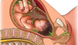 Фото: Трихомониаз при беременности